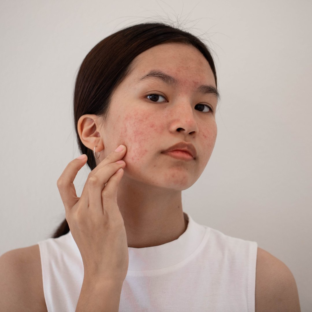 How To Become An Acne Expert – by Kin Aesthetics